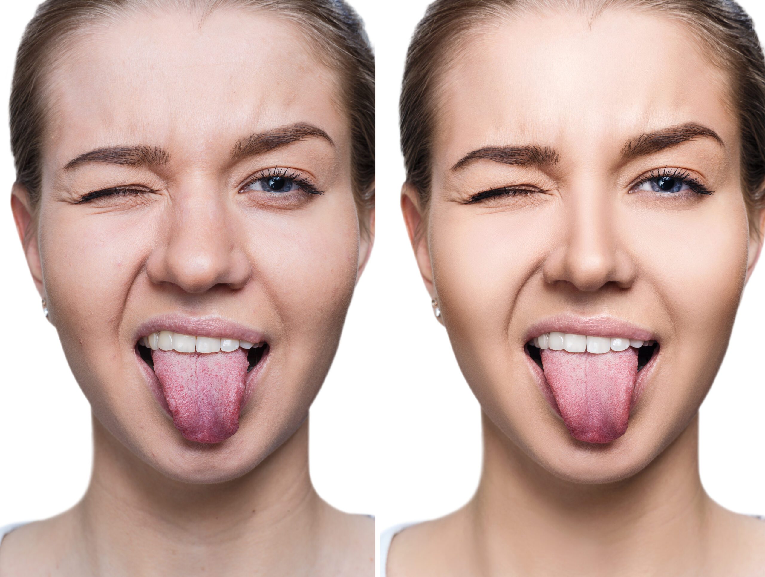 Everything You Need To Know About White Spots On The Tongue Patient 